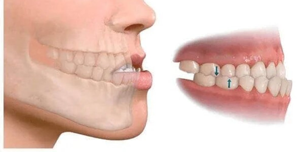 Causas Tipos Y Cuidados De La Maloclusión Dental