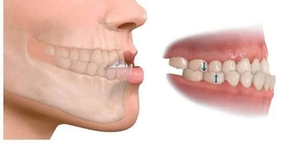 ¿Qué es la maloclusión dental? Causas, Tipos y Cuidados.